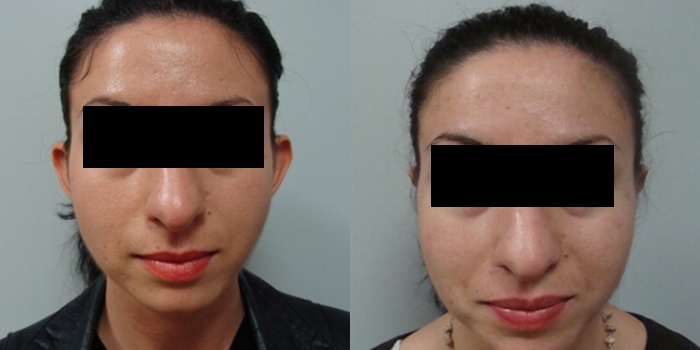 Otoplastika, nakon mjesec dana